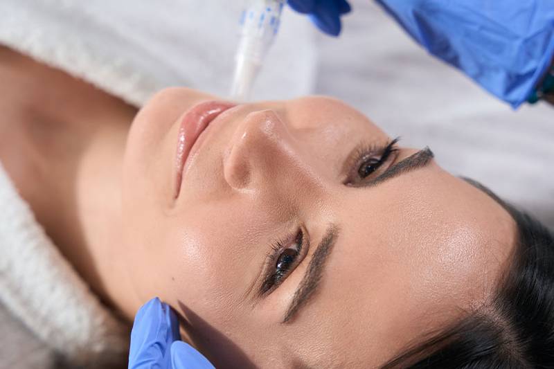 Nahaufnahme einer Microneedling-Anwendung im Gesicht mit DERMA PEN von ÄsthetikaMed im Arkona Strandhotel auf Rügen.